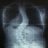 escoliosis